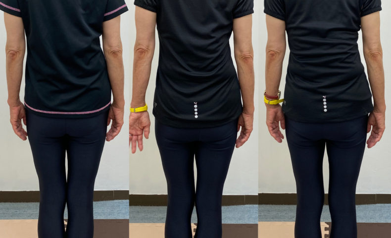 スキンストレッチによる側弯改善